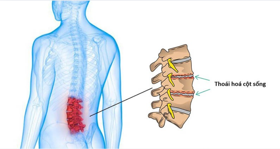 Nệm Cao Su Non Chống Thoái Hóa Cột Sống: Sự Thật & Lời Khuyên Từ Bác Sĩ